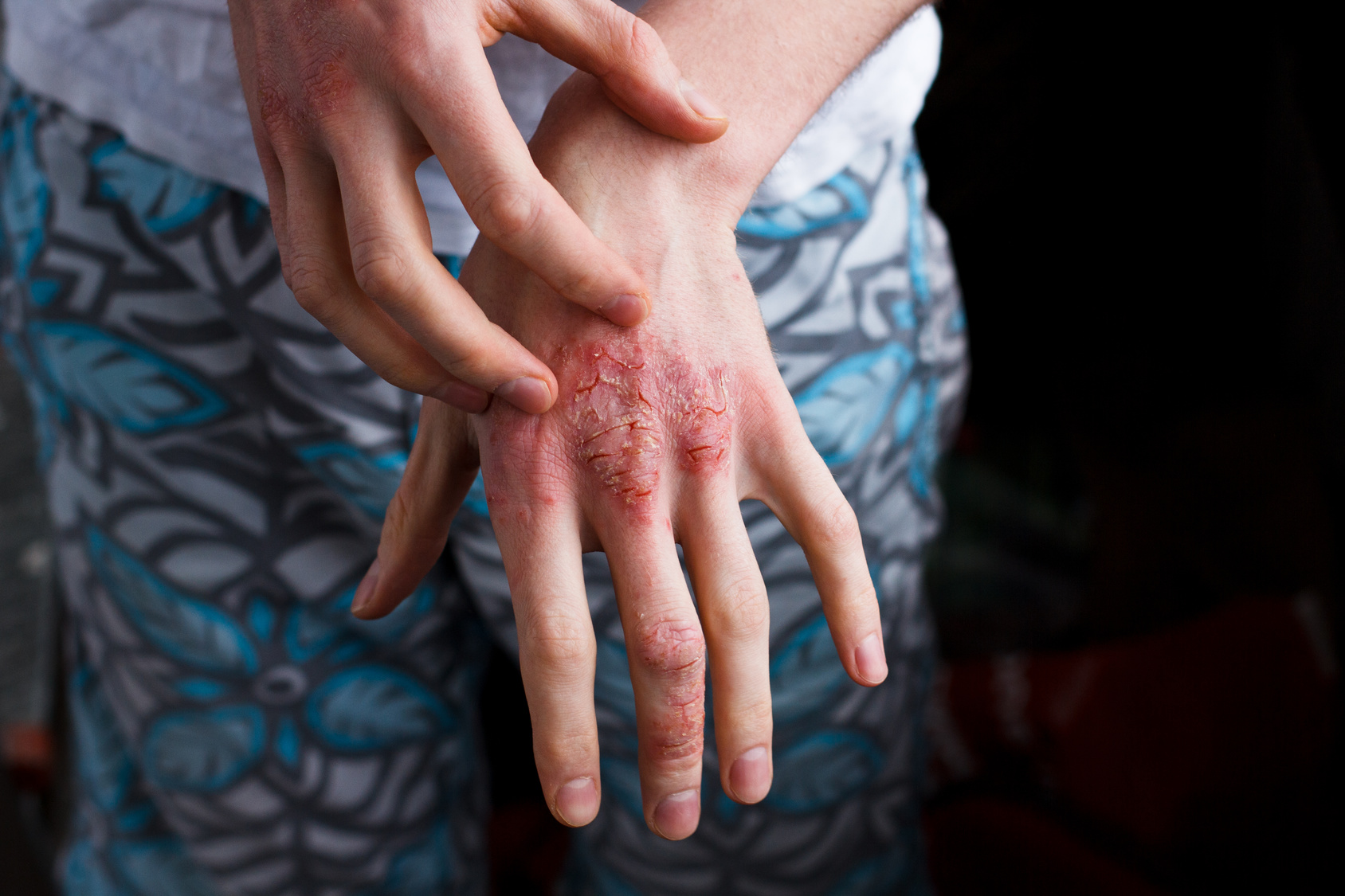 Relief for Patients with Atopic Dermatitis